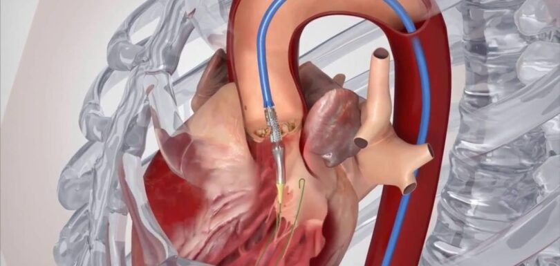 Heart valve repair and replacement surgery recovery process