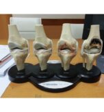Joint replacement surgical operation in India