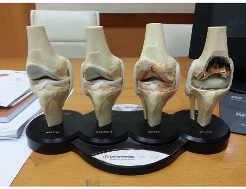 Joint replacement surgical operation in India