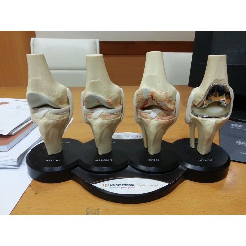 Joint replacement surgical operation in India