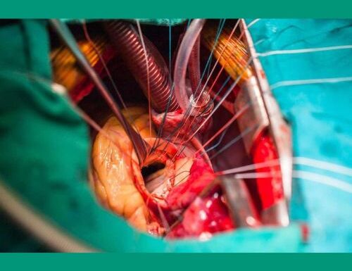 Heart valve replacement surgery in India