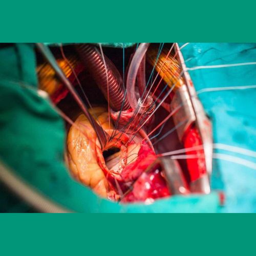 Heart valve replacement surgery in India